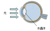 白内障手術