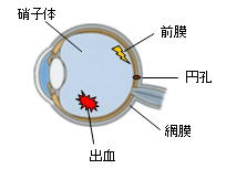 硝子体手術